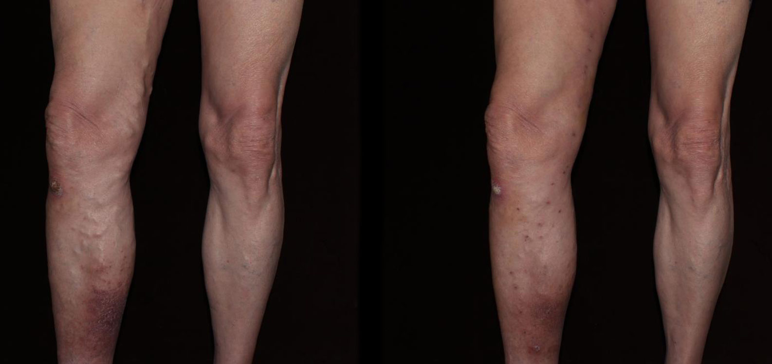 Varicose Veins Before & After