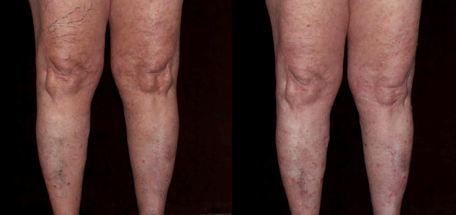 Spider Veins Before & After