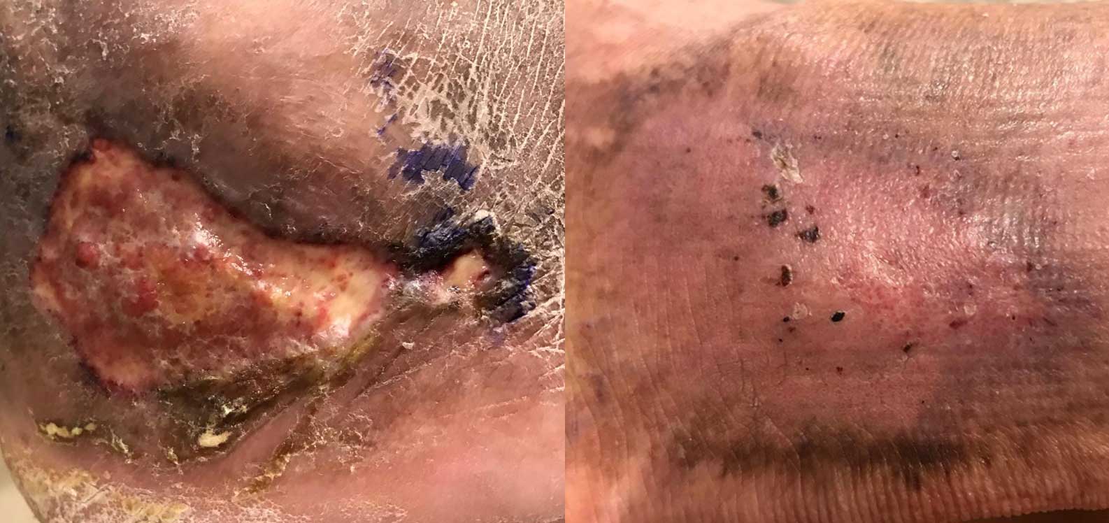 Missouri Vein Specialists Venous Ulcer before and after treatment.