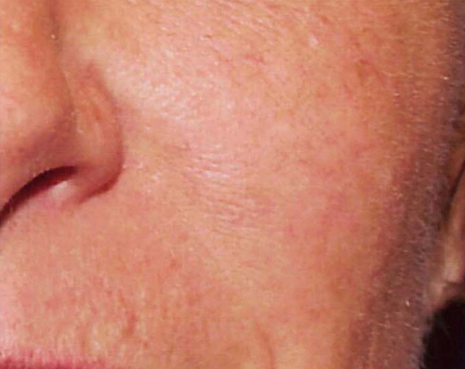 Spider veins on a patients face are completely gone after laser treatment.
