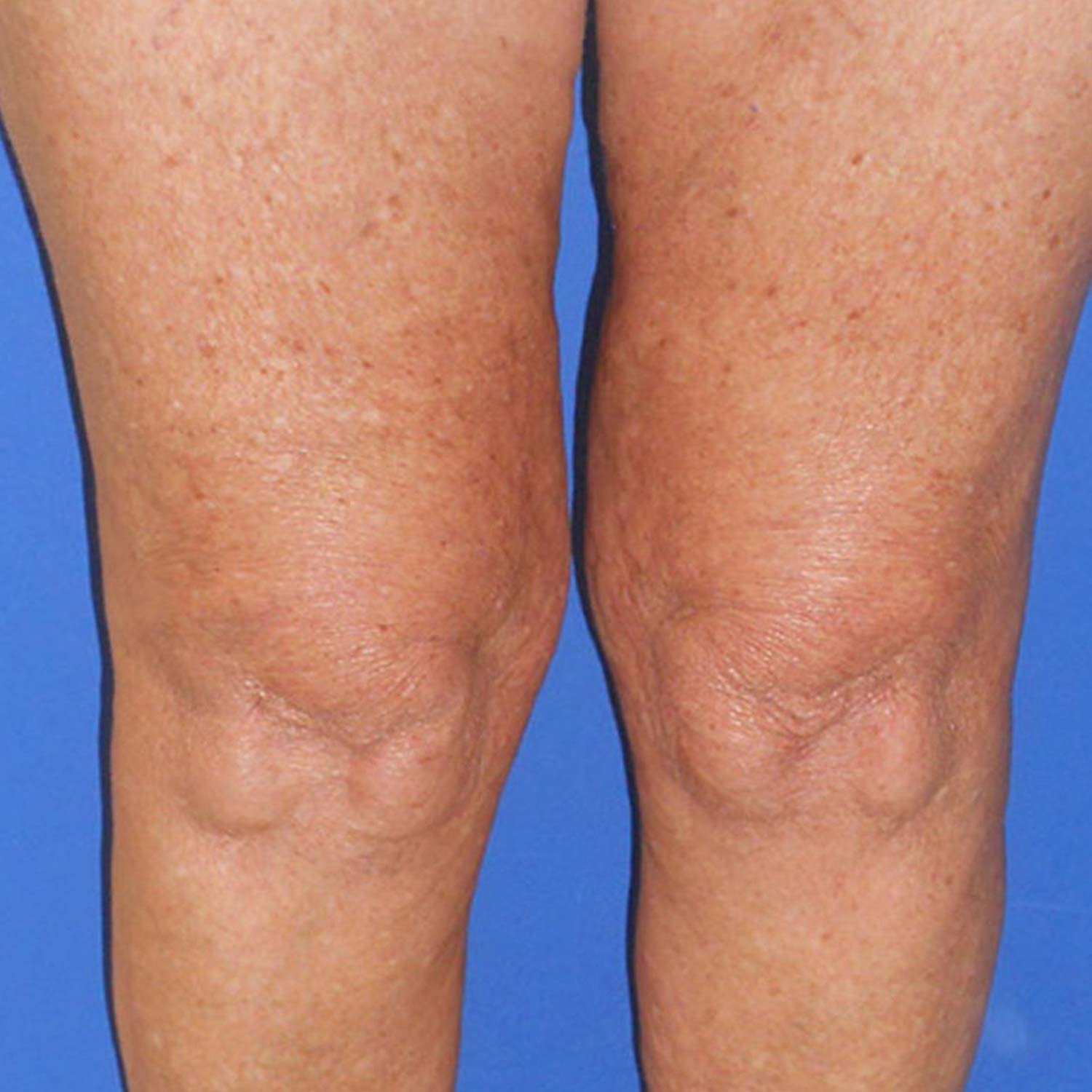 Spider veins on a patients legs are gone after surgery.