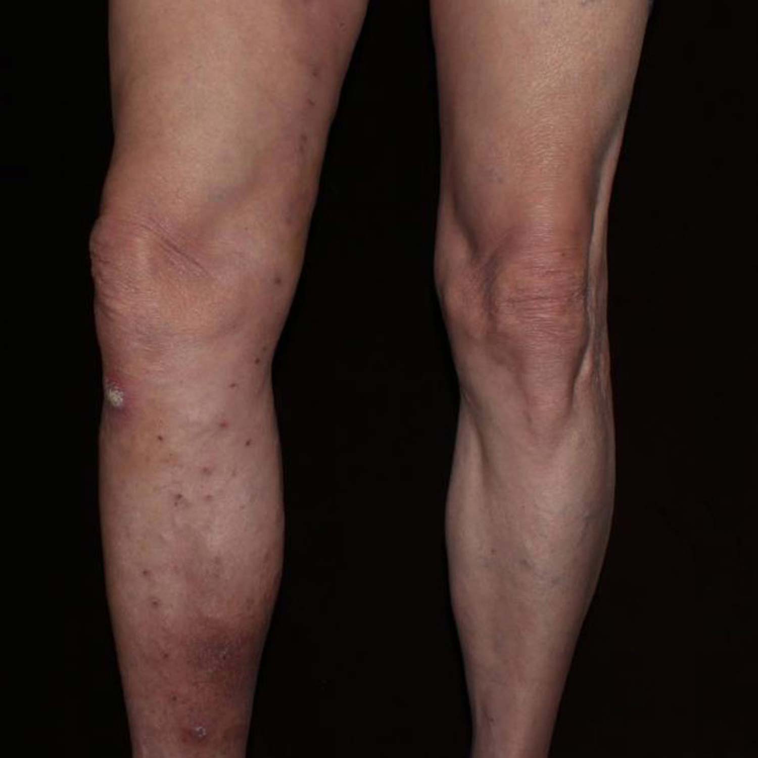 Varicose Vein after surgery is gone.