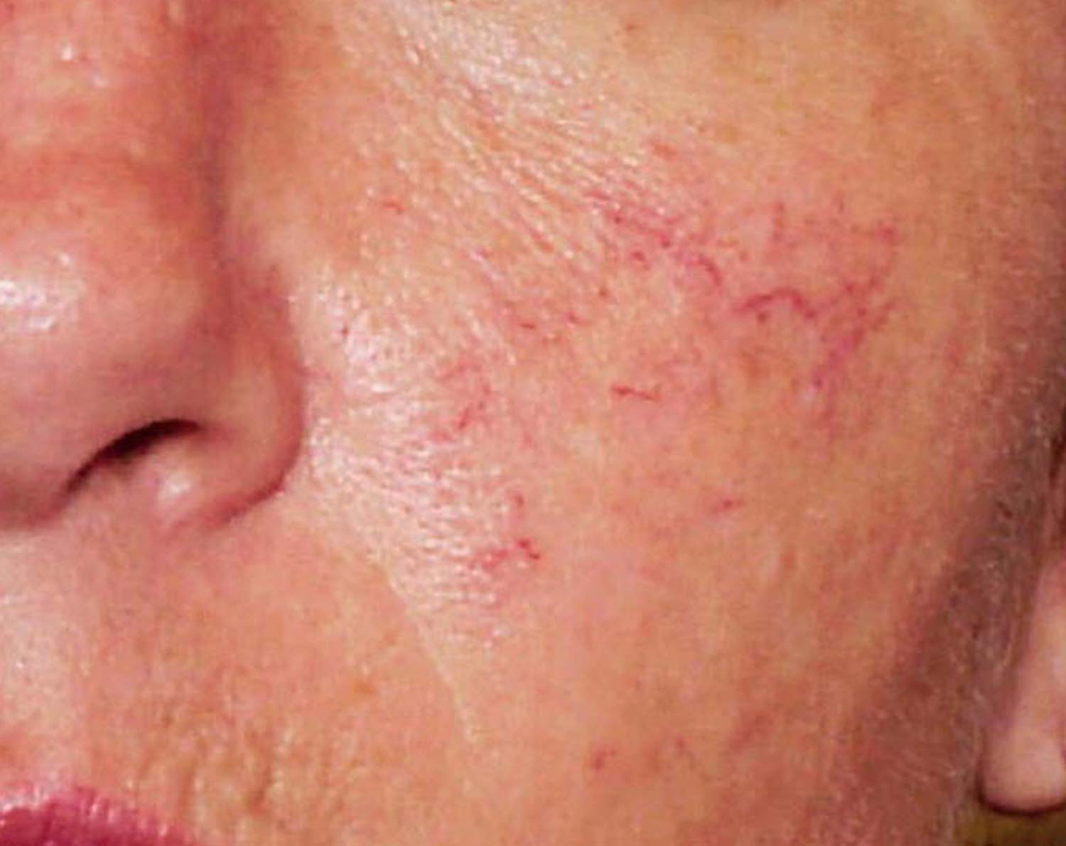 Spider veins on a patients face before laser treatment.