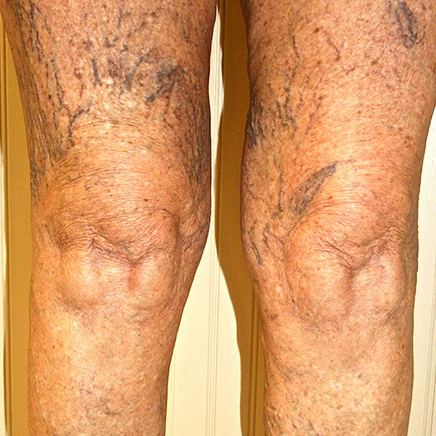 Spider veins on a patients legs before surgery.