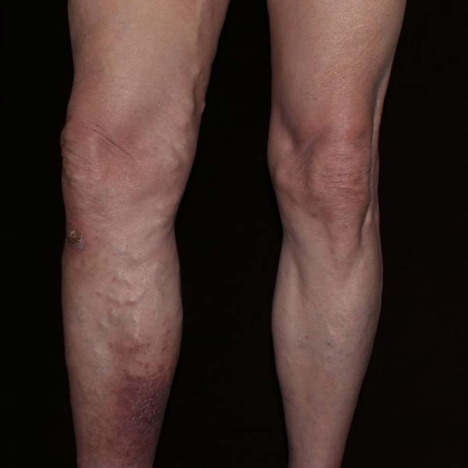 Varicose Vein before surgery.