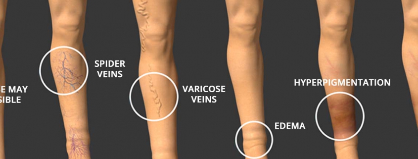 Diagram showing the progression of vein diseases. No visible signs, Spider Veins, Varicose Veins, Edema, Hyperpigmentation, Ulcer.