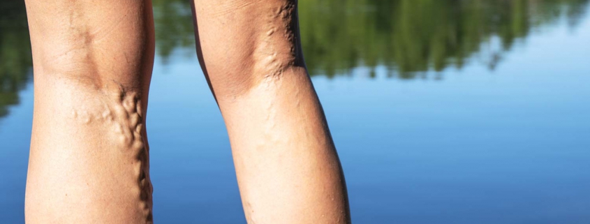 Missouri Vein Specialists Varicose Veins