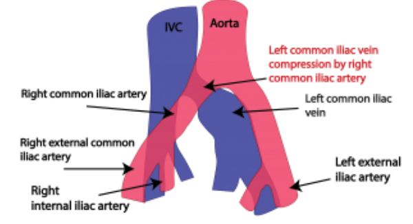 May Thurner Syndrome