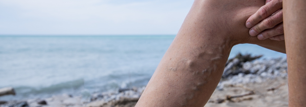 How to Prevent Varicose Veins