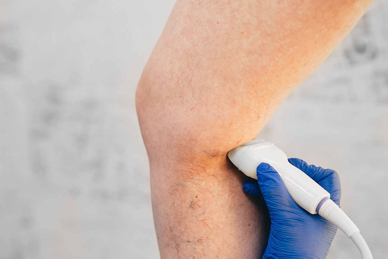 How Do Spider Veins and Varicose Veins Form? | Missouri Vein Specialists