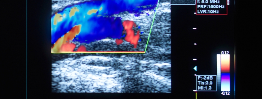 blood clot in leg ultrasound