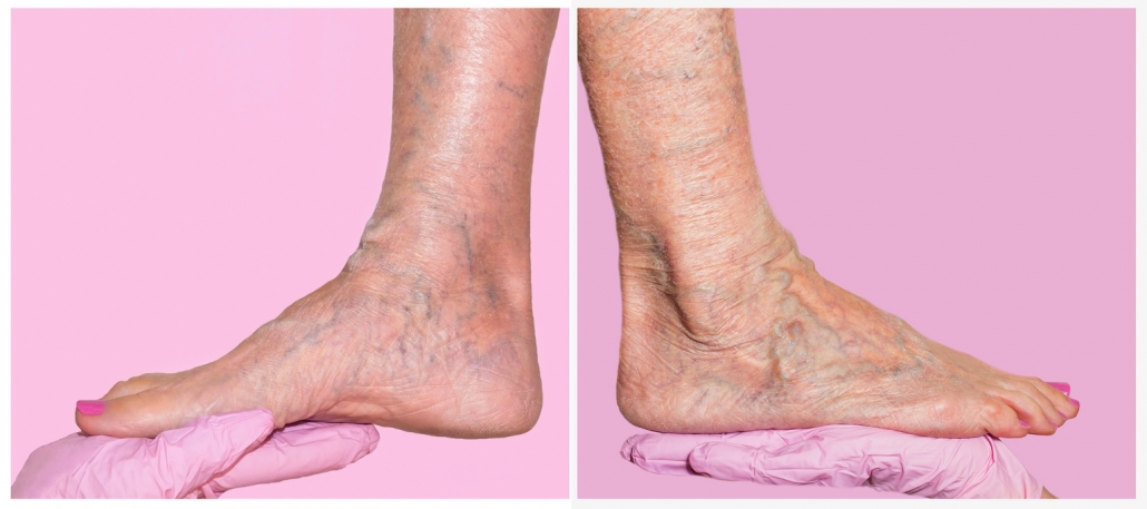 venous disease