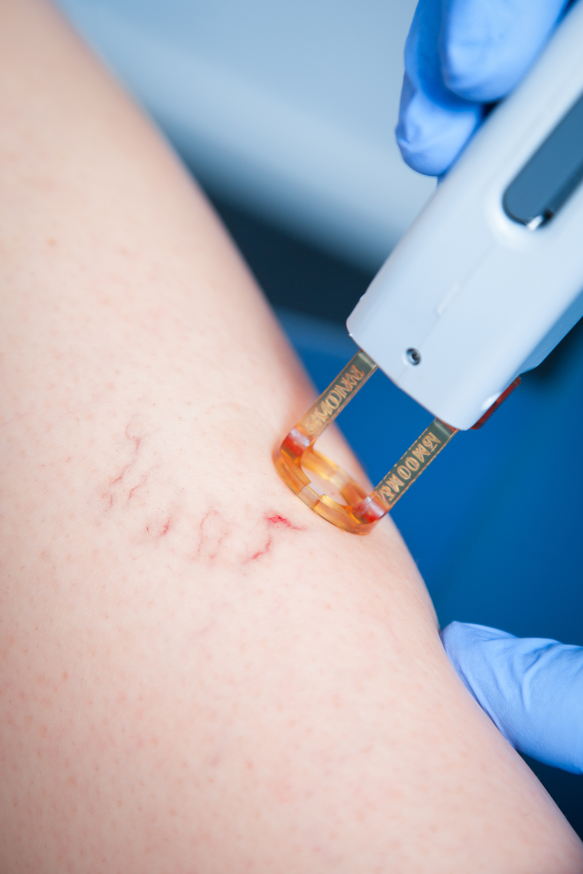 What to Expect from Your First Laser Vein Treatment Session