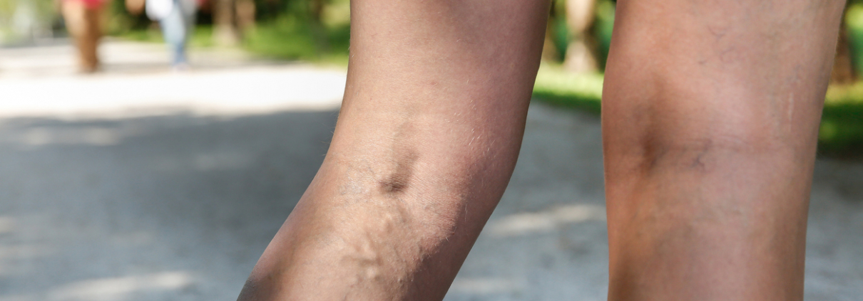 Woman with varicose veins in a park