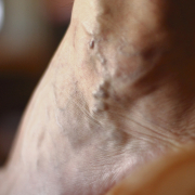 Varicose Veins on woman foot