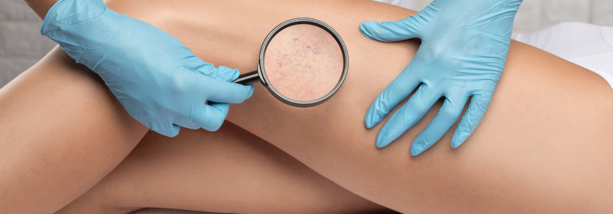 Doctor magnifying a patient's varicose veins