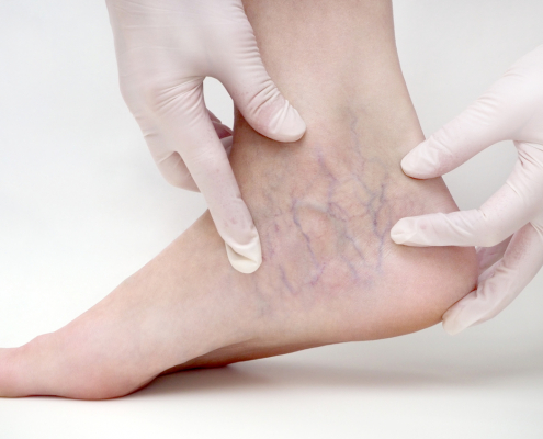 Doctor with gloves examining a patient's ankle veins