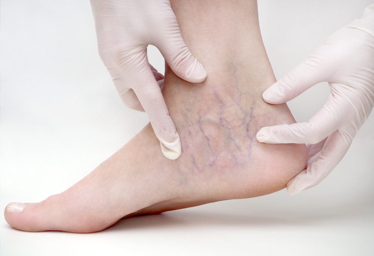 What Types of Treatment Does a Vein Surgeon Offer? Missouri Vein
