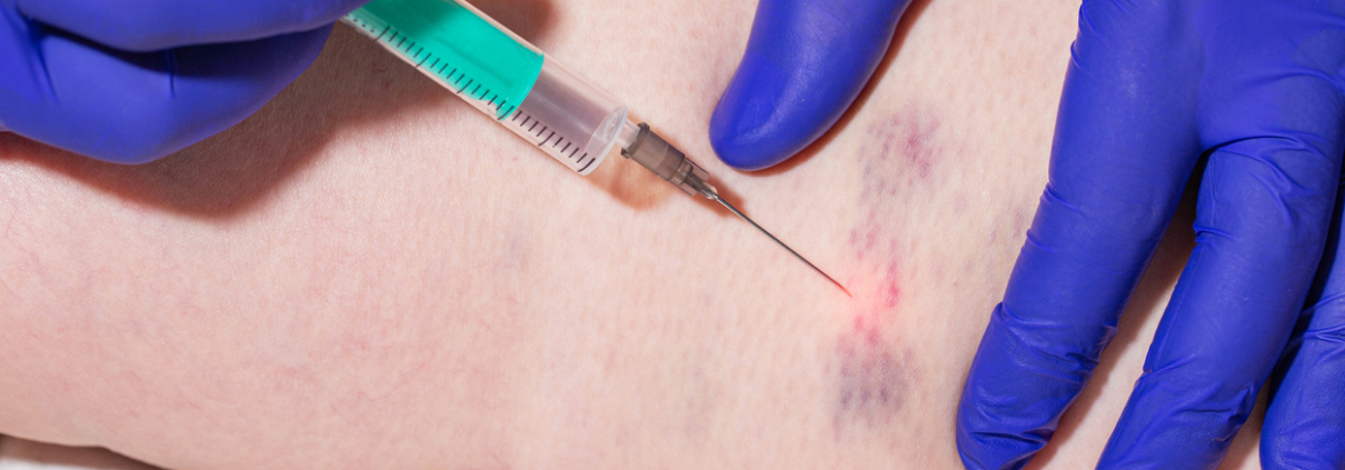 Sclerotherapy injection into a patient's ankle