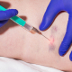 Sclerotherapy injection into a patient's ankle