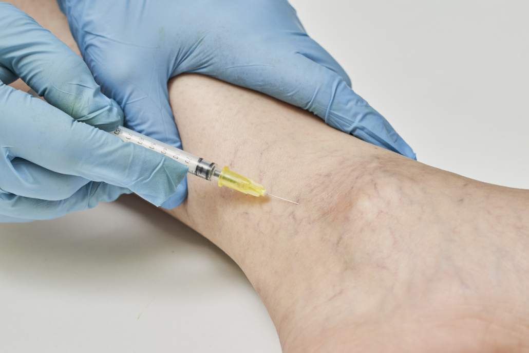 FAQs About the Sclerotherapy Procedure