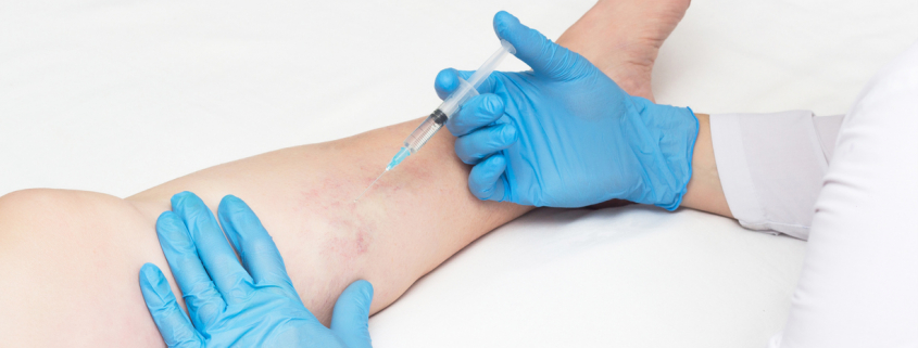 Doctor performs sclerotherapy for varicose veins on the legs