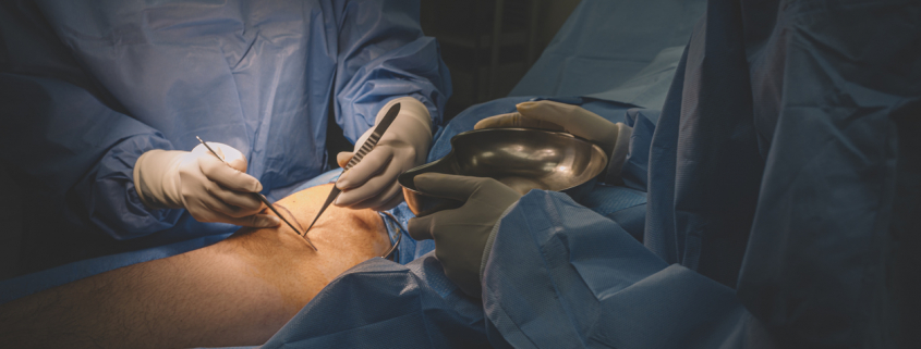 vein surgeon operation surgeon on a patient