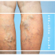 The varicose veins on female legs on blue background