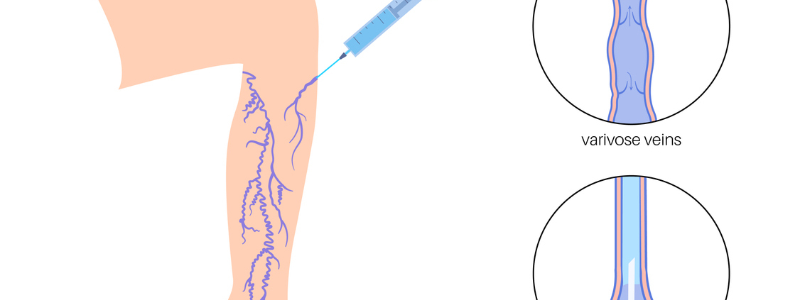 sclerotherapy procedure