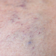 Vascular asterisk on the patient s skin. The concept of varicose veins in humans, background, macro